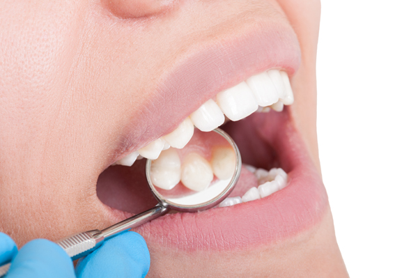 Deep Teeth Cleanings: What They Are And What To Expect