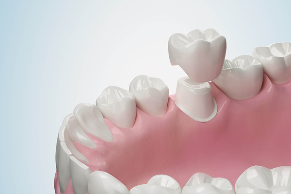 Should I Be Concerned About A Black Line Around My Dental Crown?