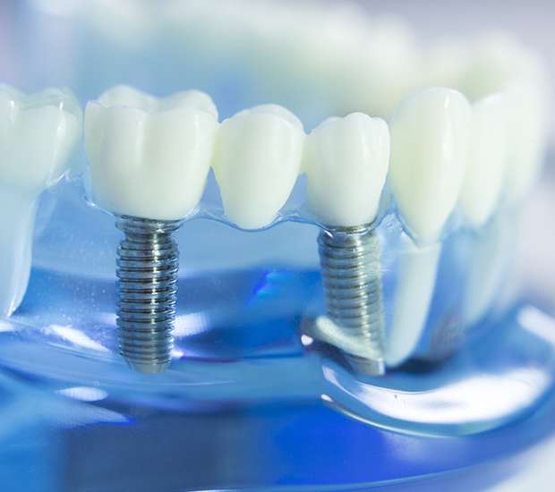Issaquah Dental Implants