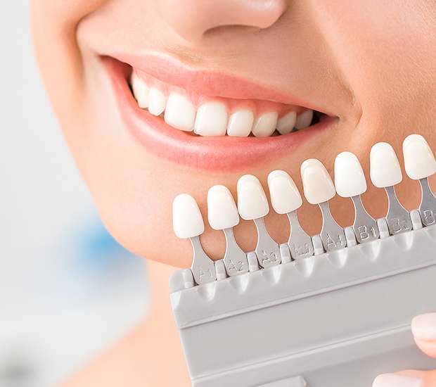 Issaquah Dental Veneers and Dental Laminates